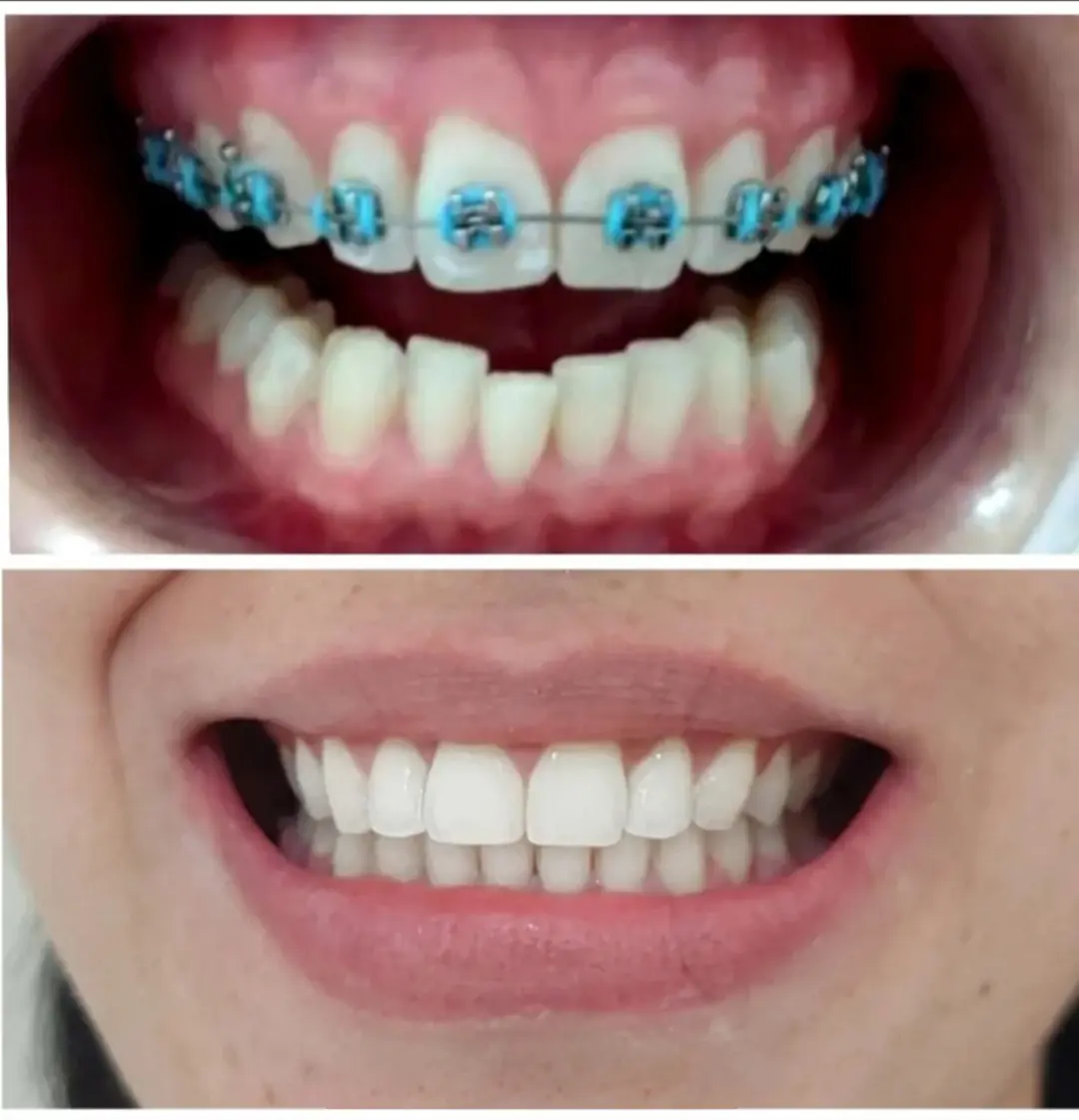 Ortodontia — registro fotográfico de caso clínico real, antes e depois