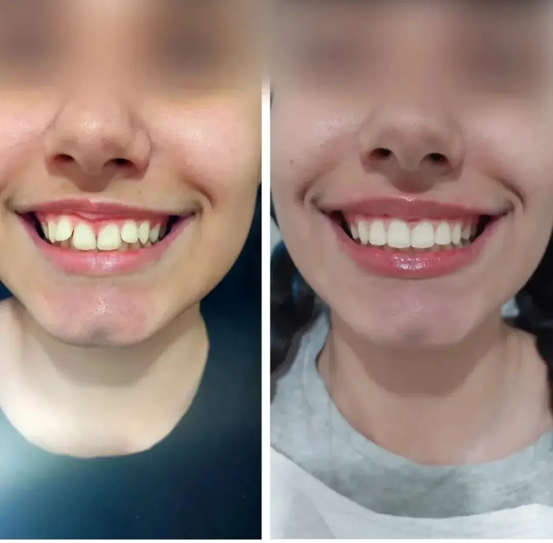 Ortodontia — registro fotográfico de caso clínico real, antes e depois
